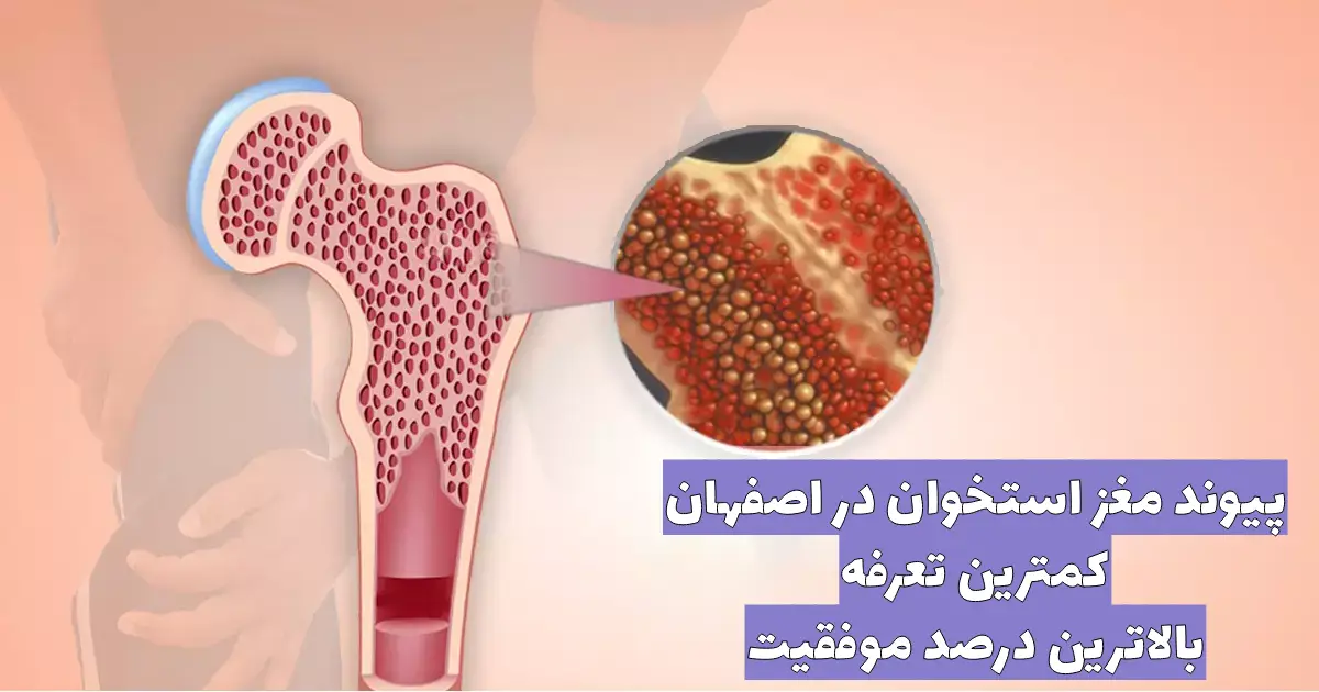 هزینه پیوند مغز استخوان در ایران | چرا اصفهان بهترین انتخاب است؟